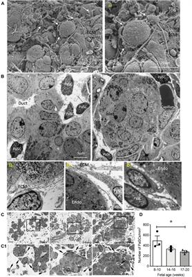 Activation of Pancreatic Stellate Cells Is Beneficial for Exocrine but Not Endocrine Cell Differentiation in the Developing Human Pancreas